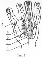 Способ реконструкции пальцев при врожденной патологии кисти (патент 2307612)