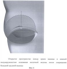 Способ формирования кармана для имплантата в двойственной плоскости при аугментационной маммопластике (патент 2501528)