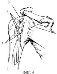 Способ хирургического лечения привычного вывиха плеча (патент 2392895)