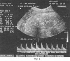 Способ оценки состояния плода и прогнозирования состояния новорожденного при сахарном диабете матери по показателям кровотока при допплерометрическом исследовании (патент 2251976)