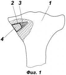 Способ лечения импрессионного перелома метаэпифизарного отдела трубчатой кости (патент 2444319)