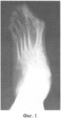 Способ лечения вальгусной деформации 1-го пальца стопы при детском церебральном параличе (патент 2489108)