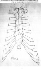 Способ восстановления целостности грудины после стернотомии многостежковым швом (патент 2598969)