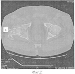 Способ обоснования выбора тазобедренного сустава при эндопротезировании больных двусторонним коксартрозом (ка) с одинаковой рентгенологической стадией дегенеративного процесса (патент 2417754)