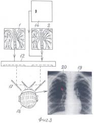 Способ ретроспективного анализа рентгеновских снимков (патент 2326597)