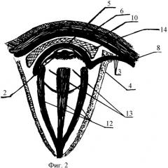 Способ субкутанной аутофасциально-мышечной пластики с виска полного обширного симблефарона (патент 2329779)