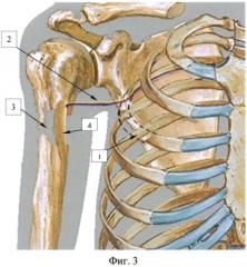 Способ пересадки кровоснабжаемого трансплантата третьего ребра для замещения дефектов плечевой кости (патент 2563957)