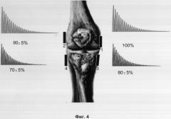 Способ исследования биомеханических свойств суставов (патент 2302199)