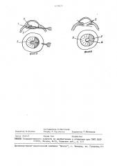 Способ формирования зрачка при экстракции катаракты у больных с аниридией (патент 1479073)