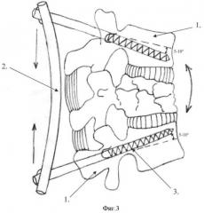 Способ коррекции травматического кифоза при взрывных переломах позвоночника у детей (патент 2364366)