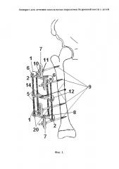 Аппарат для лечения оскольчатых переломов бедренной кости у детей (патент 2629050)