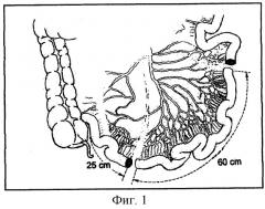 Способ ортотопической кишечной пластики мочевого пузыря (патент 2279254)