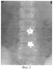 Способ соединения тел позвонков (патент 2340302)