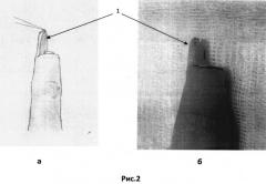 Способ восстановления ногтевого матрикса пальца кисти (патент 2494682)
