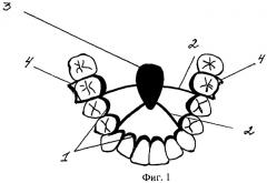 Ортодонтическое устройство (патент 2275882)