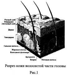 Метод лечения андрогенной алопеции: местное нанесение на очаги облысения гепарина (в составе препаратов для местного лечения) (патент 2517087)