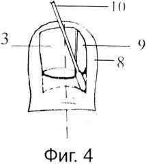 Способ лечения вросшего ногтя с использованием аппарата 