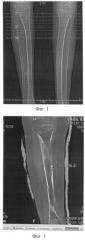 Способ определения степени резорбции кортикальной пластинки кости после дистракционного удлинения конечности (патент 2484772)