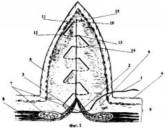 Способ ушивания лапаротомной раны (патент 2261665)