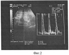 Способ оценки кровотока в нижней брыжеечной артерии методом триплексного сканирования у больных колоректальным раком (патент 2400144)