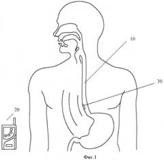 Следящая система, аппаратура и способ позиционирования для беспроводного мониторинга уровня ph в пищеводе (патент 2522970)