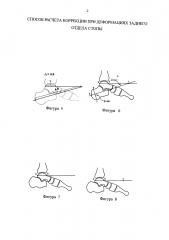 Способ расчета коррекции при деформациях заднего отдела стопы (патент 2634043)
