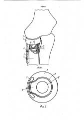 Эндопротез головки лучевой кости (патент 1734727)