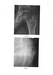 Способ лечения дефекта головки бедра (патент 2637290)
