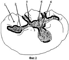Способ пломбирования кариозной полости (патент 2285496)