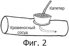 Хирургическое ввинчиваемое устройство (патент 2359715)