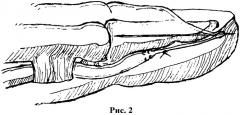 Способ лечения повреждения сухожилия глубокого сгибателя пальца кисти в i зоне (патент 2458650)