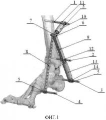 Способ восстановления целостности и функциональности пяточной кости человека и аппарат для его осуществления (патент 2566663)