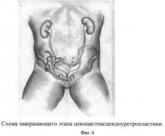 Способ цекоцистоасцендоуретропластики при экстрофии клоаки (патент 2400154)