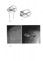 Устройство для лечения переломов большого бугорка плечевой кости (патент 2614097)