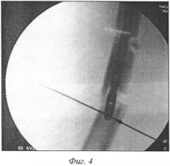 Способ репозиции фрагментарных переломов бедренной кости (патент 2562678)