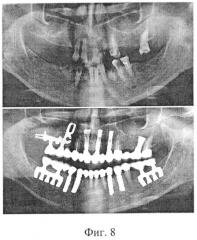 Дентальный внутрикостно-поднадкостничный имплантат и способ его установки (патент 2529472)