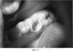 Способ лечения глубокого кариеса зубов (патент 2277901)