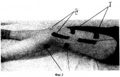 Способ комплексной реабилитации коленного сустава (патент 2253385)