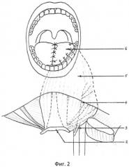 Способ реконструкции языка и дна полости рта (патент 2546097)