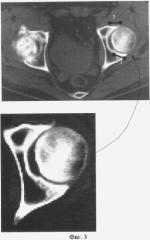 Способ диагностики локальных участков компрессии тазобедренного сустава у больных коксартрозом методом компьютерной томографии (патент 2377954)