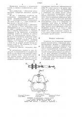 Устройство для исправления воронкообразной грудной клетки (патент 1279621)