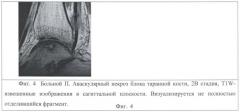 Способ выявления и оценки аваскулярного некроза блока таранной кости с использованием магнитно-резонансной томографии (патент 2403867)