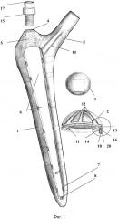 Устройство для эндопротезирования тазобедренного сустава (варианты) (патент 2611926)
