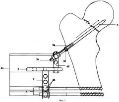 Устройство для остеосинтеза медиальных переломов шейки бедренной кости (патент 2337645)