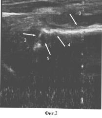Способ ультразвуковой диагностики острого гематогенного метаэпифизарного остеомиелита у детей грудного возраста (патент 2503413)