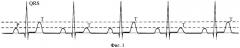 Способ выявления альтернаций т-зубца электрокардиосигнала в режиме реального времени и устройство для его осуществления (патент 2371087)