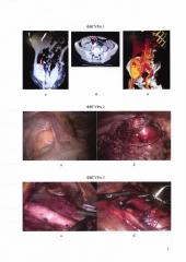 Способ временного гемостаза при лапароскопической резекции трансплантата почки (патент 2665119)