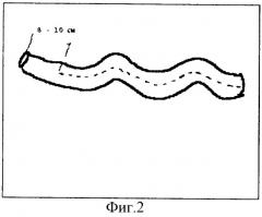 Способ гетеротопической пластики мочевого пузыря (патент 2286098)