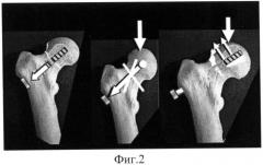 Способ остеосинтеза переломов шейки бедра и устройство для его осуществления (патент 2525739)