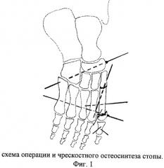 Способ оперативного лечения больных с субтотальным дефектом плюсневой кости и плоскостопием (патент 2412662)